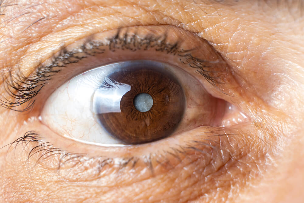 Alternatives of Cataract Surgery