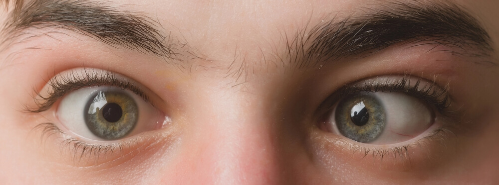 Can LASIK Fix Lazy Eye