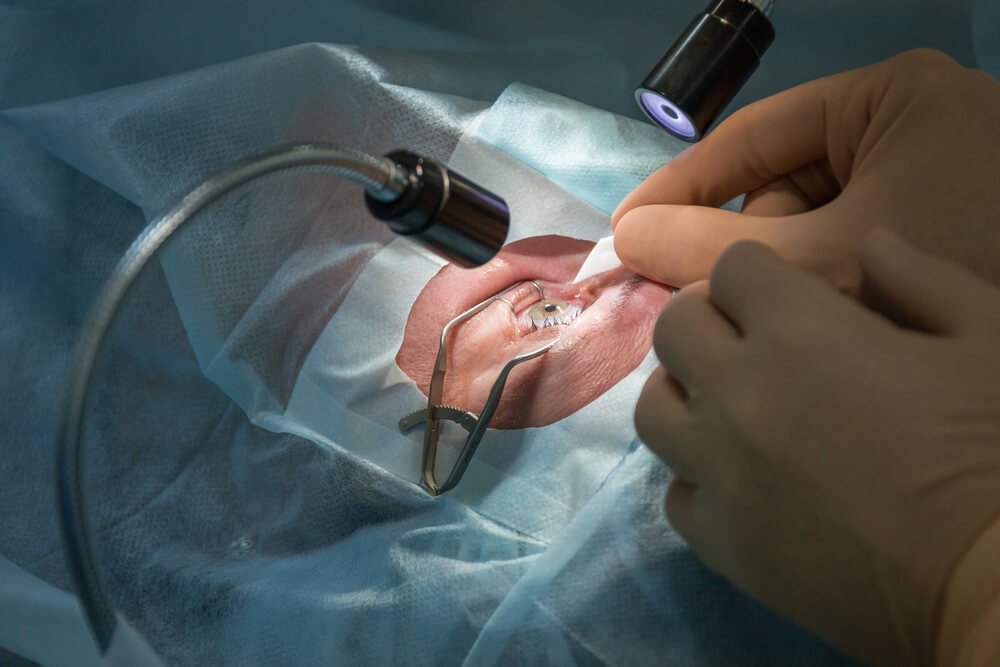 Flap Dislocation after LASIK