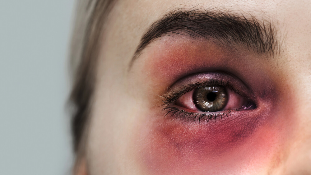 Getting hit in the eye after LASIK