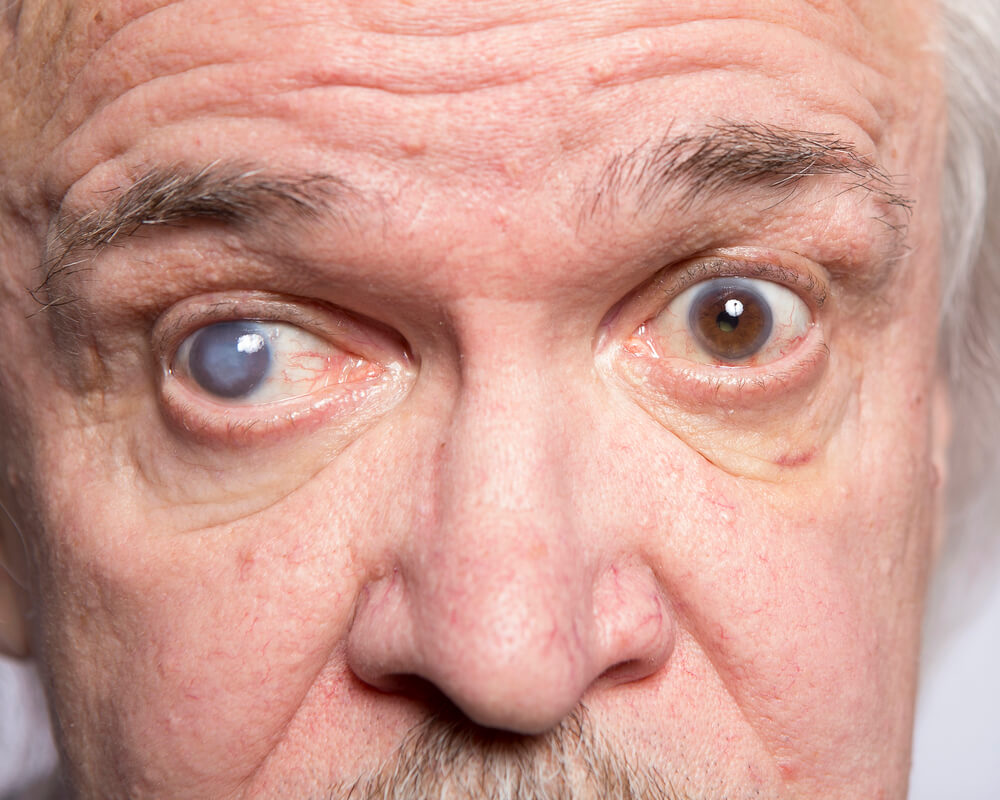 Will Cataracts Lead to Blindness?